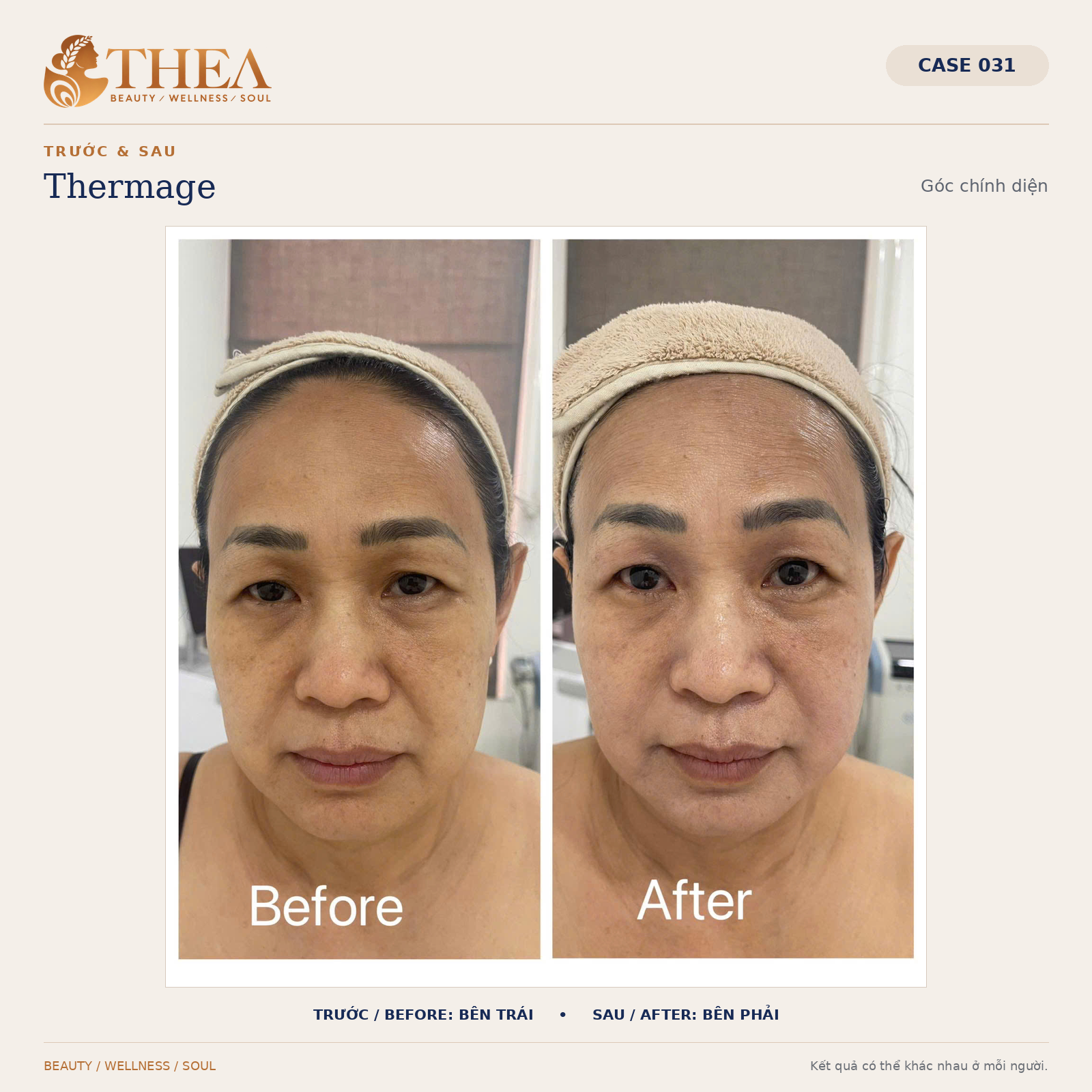 Trước và sau Thermage — case 031