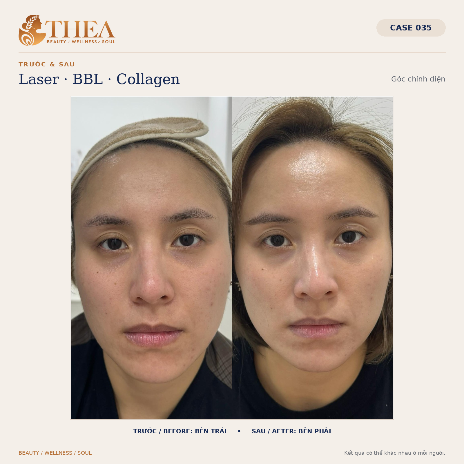 Trước và sau Laser BBL Collagen — case 035