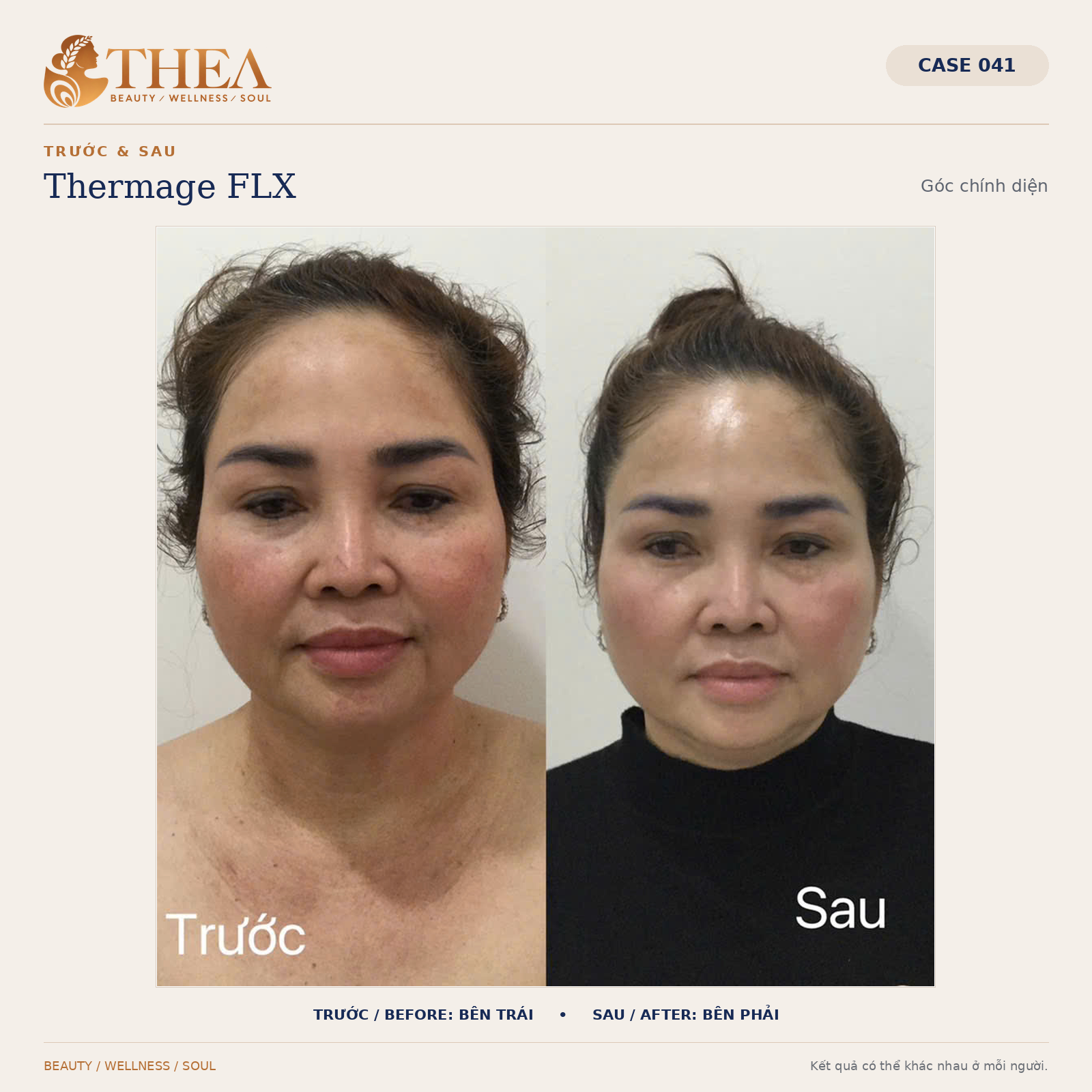 Trước và sau Thermage FLX — case 041