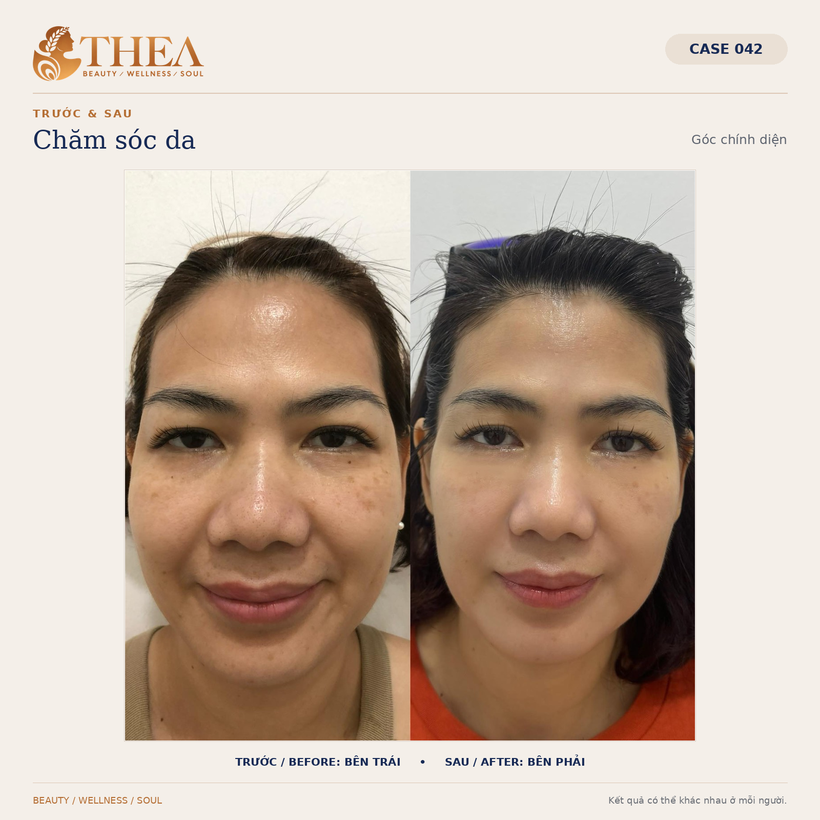 Trước và sau chăm sóc da — case 042