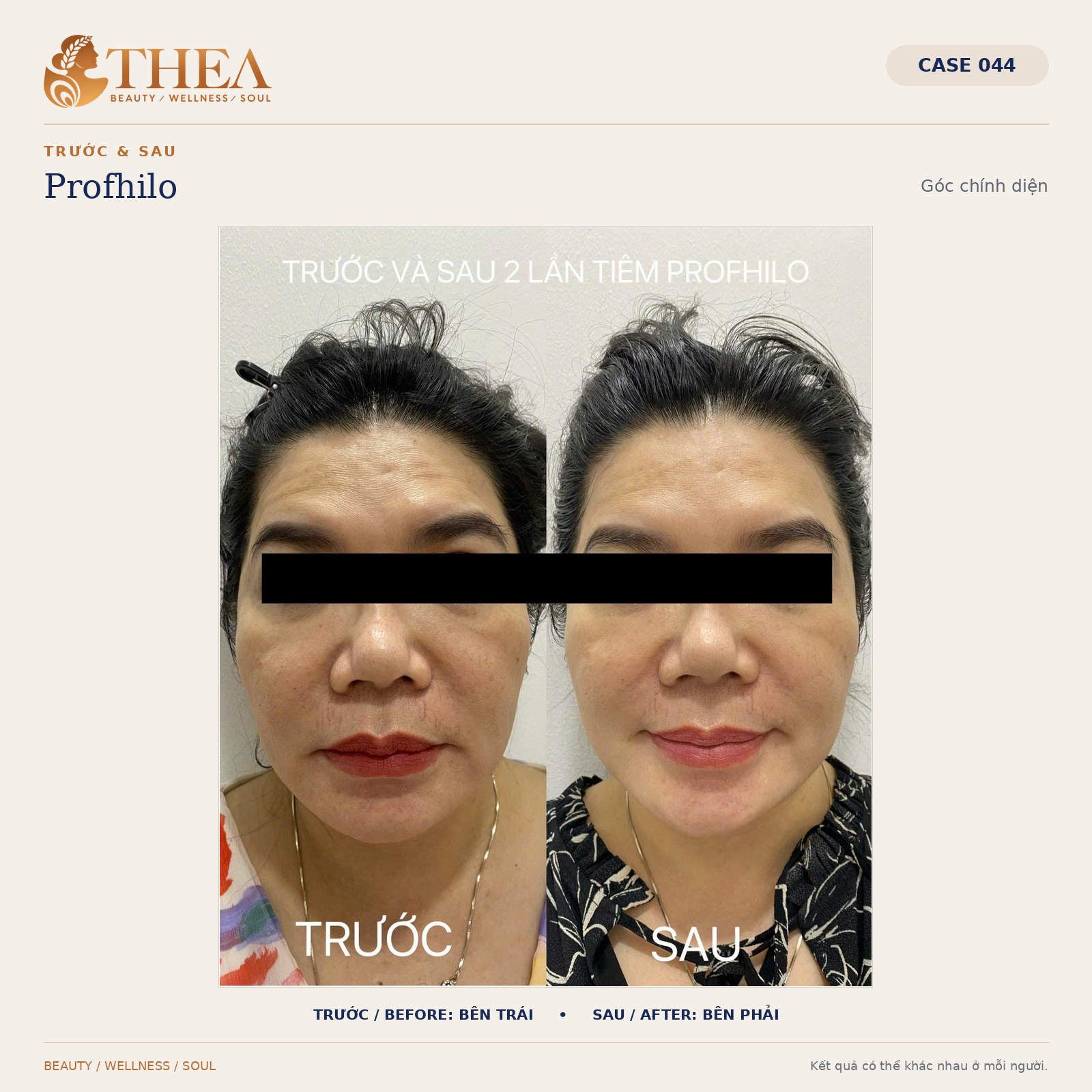 Trước và sau Profhilo — case 044