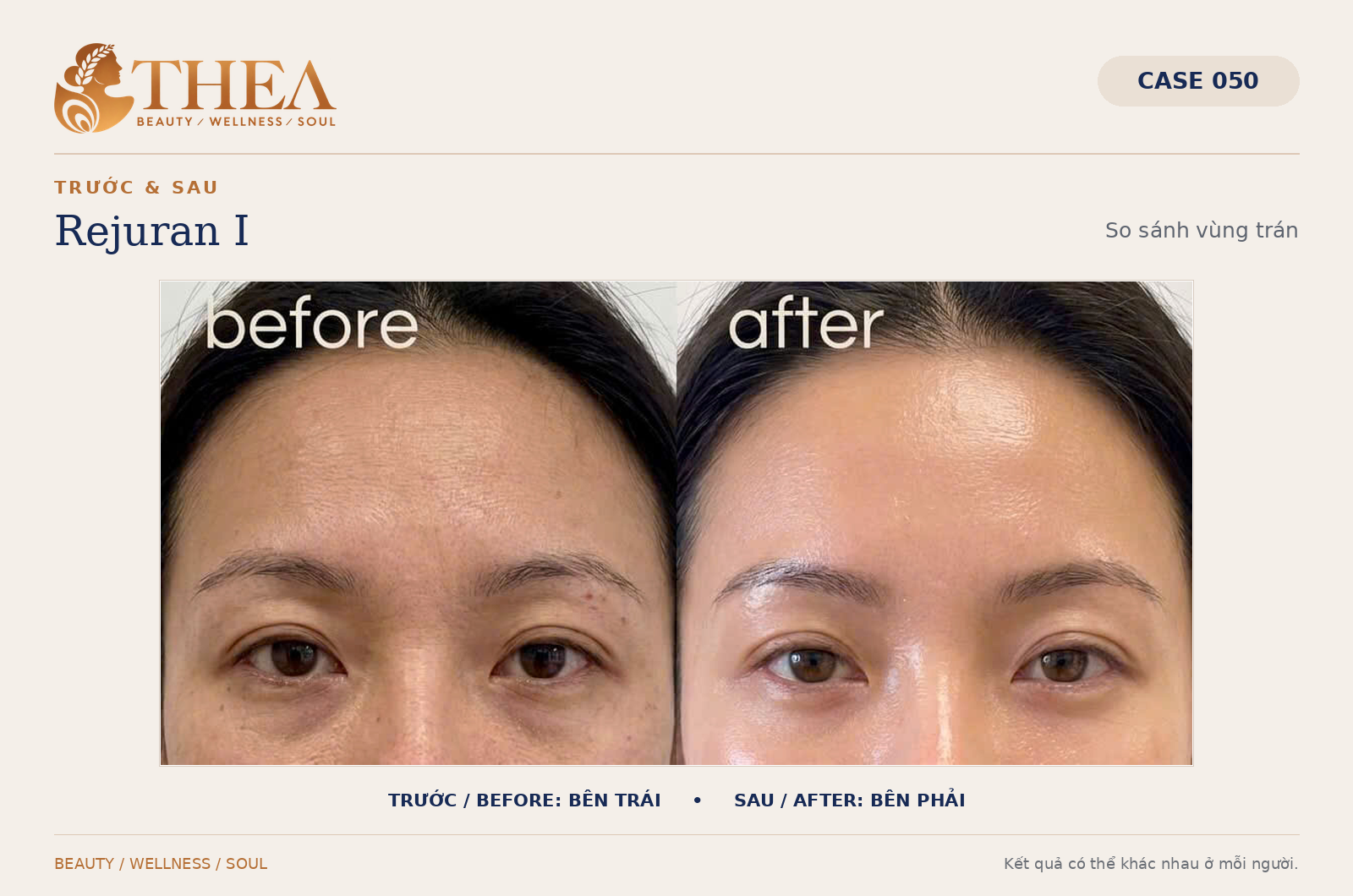 Trước và sau Rejuran I — case 050