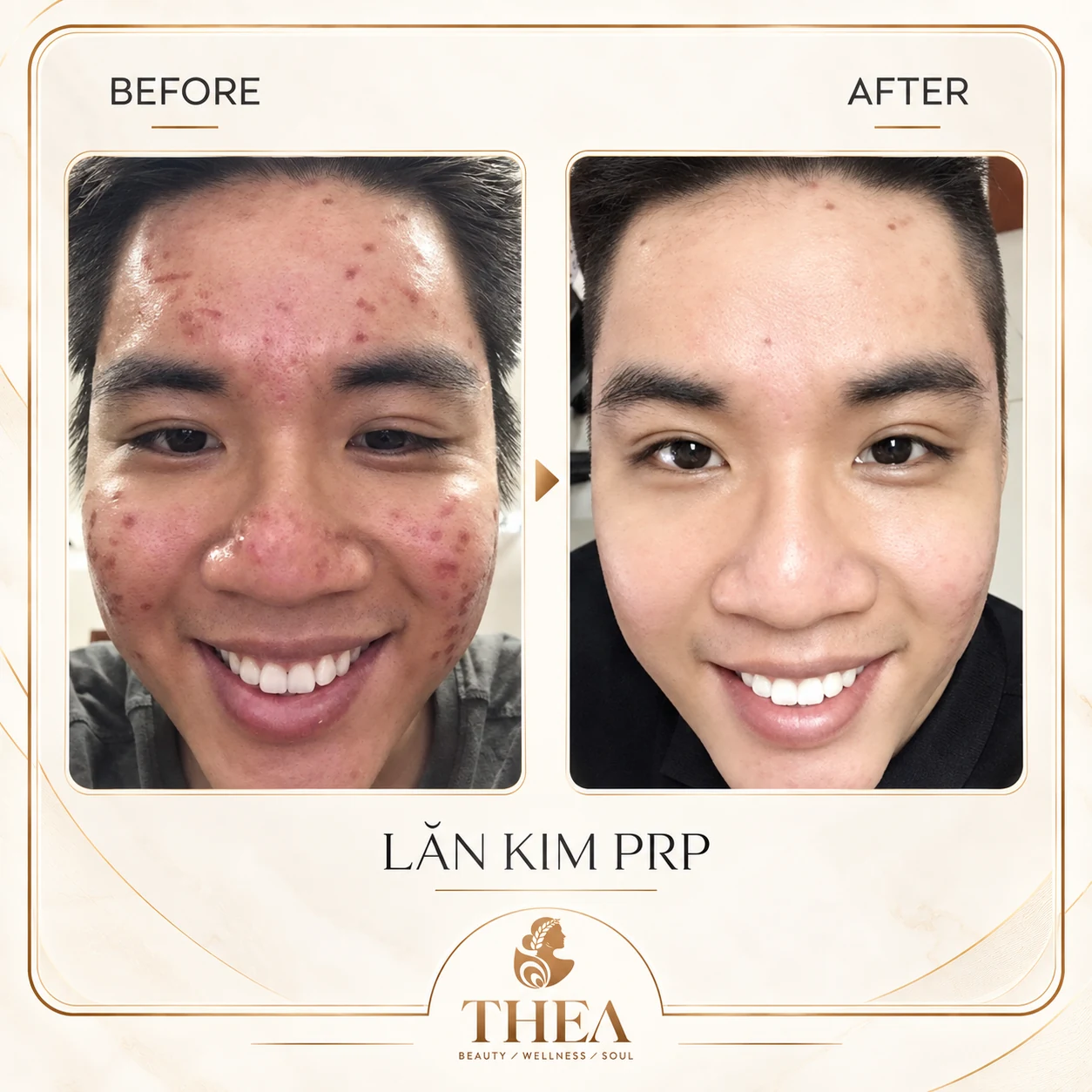 Trước và sau — Lăn kim PRP