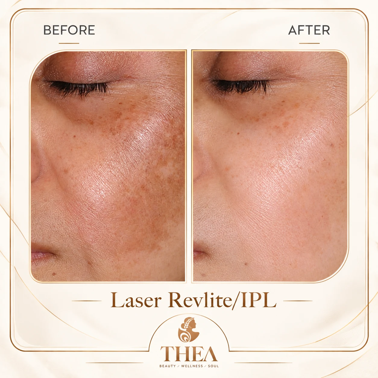 Trước và sau — Laser Revlite + IPL