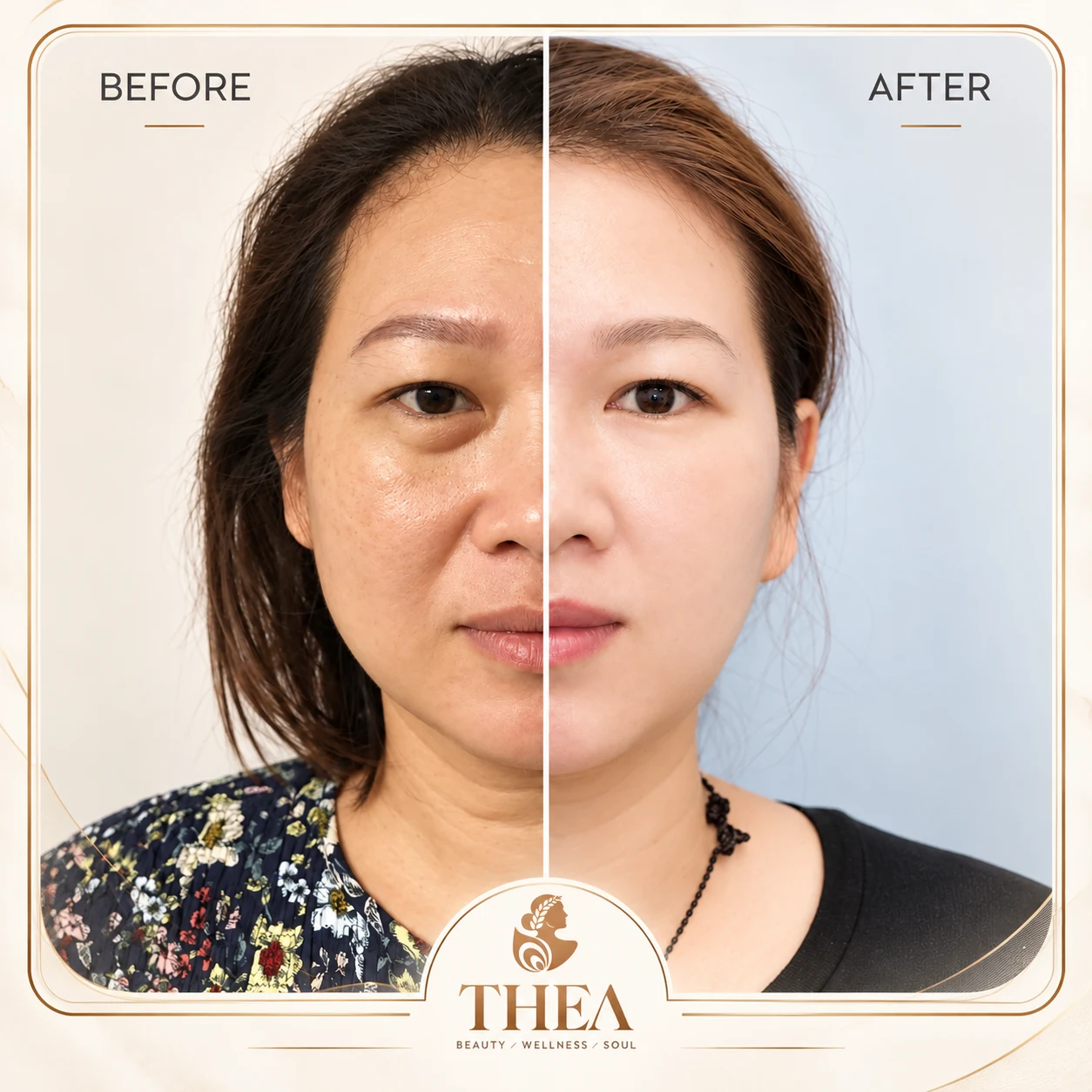 Trước và sau — Mẫu THEA