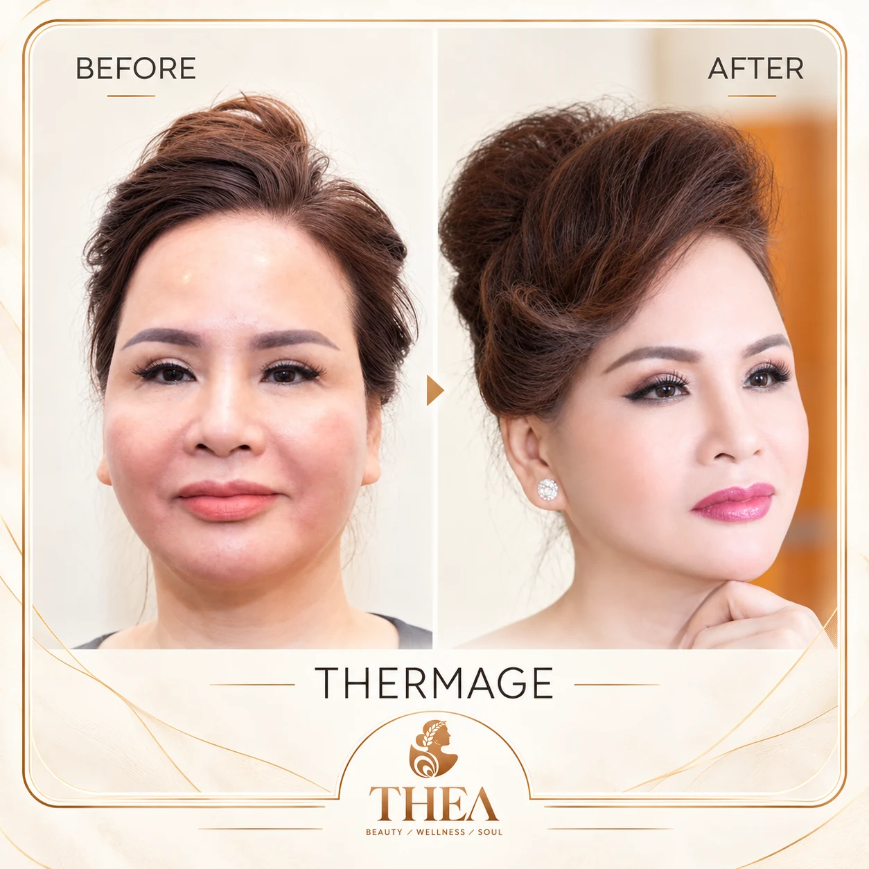 Trước và sau — Thermage