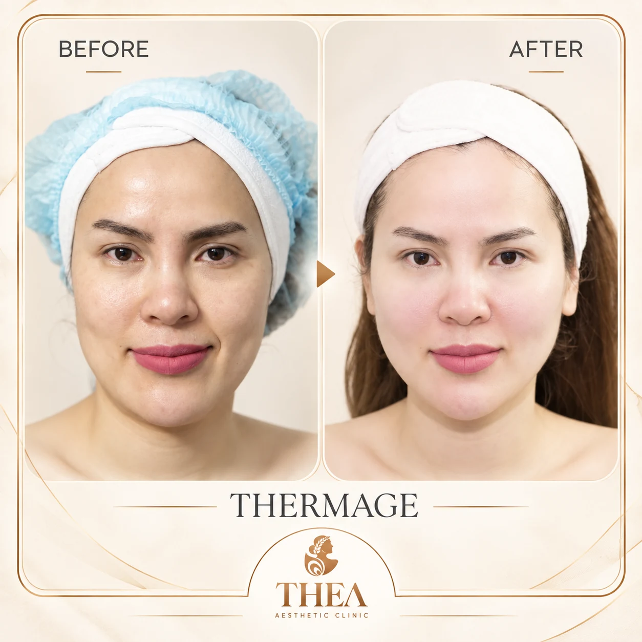 Trước và sau — Thermage